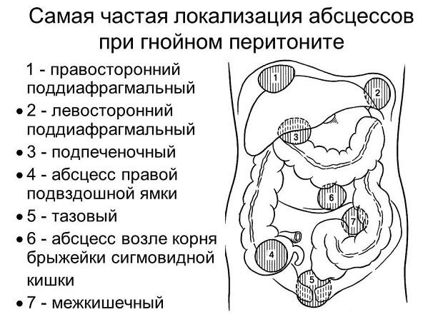 Локализация абсцессов