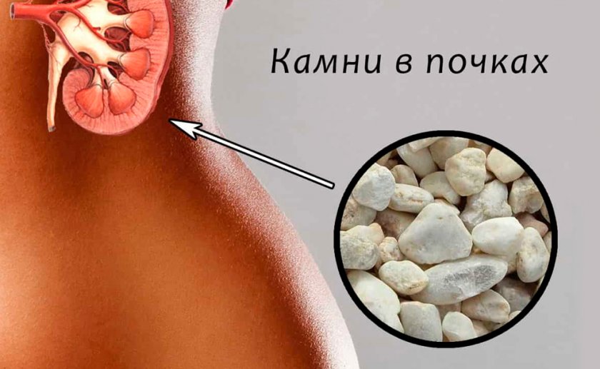 Камни в почках