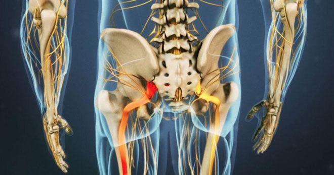 Основным симптомом является боль в области поясницы, ягодиц и с распространением вдоль задней поверхности ноги.
