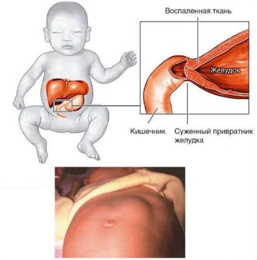 Пилоростеноз у младенца