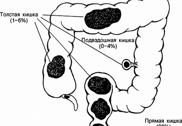 Каловые массы в толстой кишке