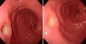 Диагностика язвенной болезни желудка