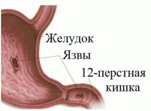 Поражение внутри желудка и кишки