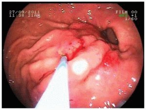 Гастроскопия желудка