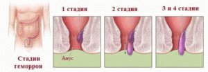 Стадии геморроя