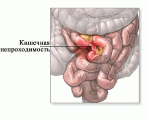 Кишечная непроходимость