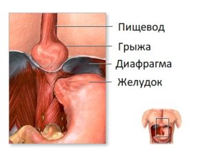 Заболевание диафрагмальная грыжа