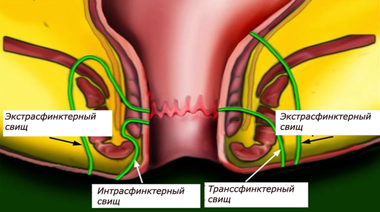 Виды свищей