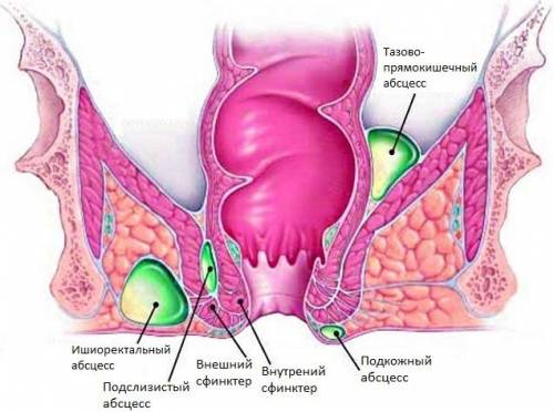 Последствия геморроя