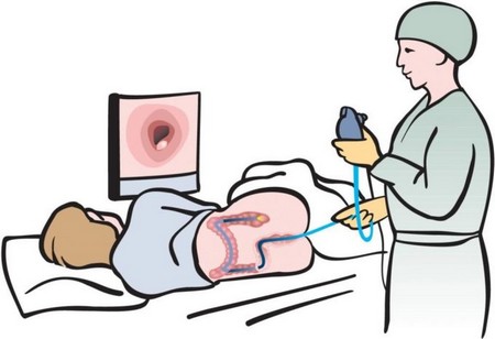 Колоноскопия кишечника 