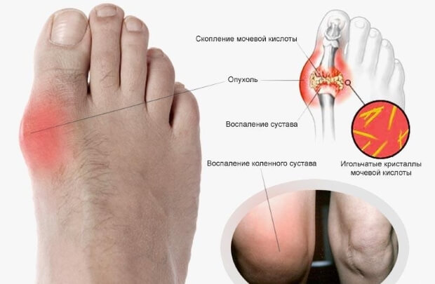 Поражение суставов подагрой