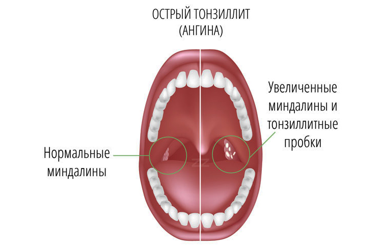 Острый тонзиллит