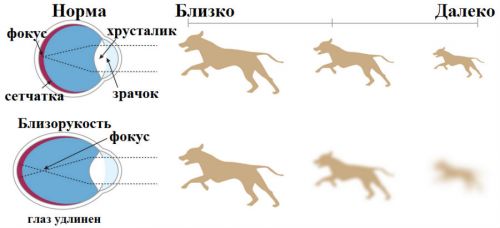 Зрение при миопии