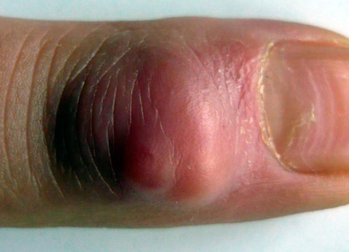 Симптомами панариция являются боль, сильный отек и покраснение кожи на пальце.