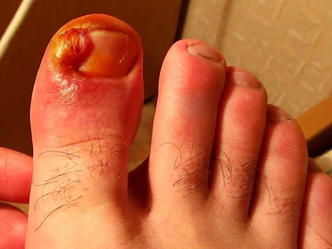 Нарыв около ногтя на пальце ноги.