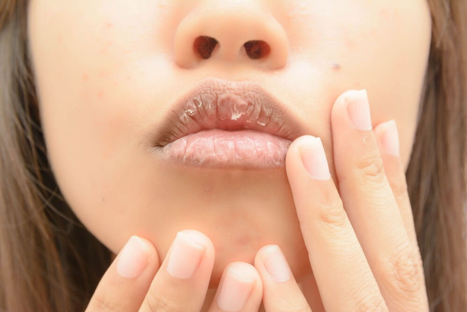 Почему губы сохнут после 40 лет?