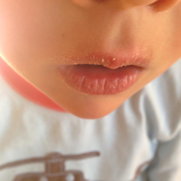 Почему губы сохнут, шелушатся и трескаются у детей?