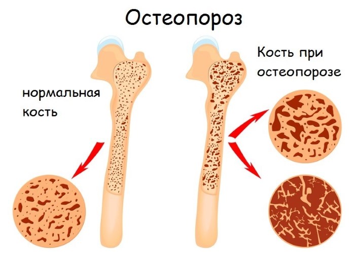 Причины боли в пятках ног при ходьбе, больно наступать. Как лечить, народные средства