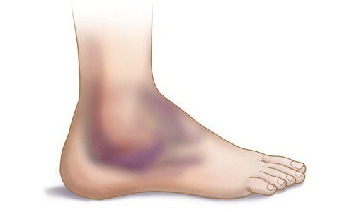 Причины боли в пятках ног при ходьбе, больно наступать. Как лечить, народные средства