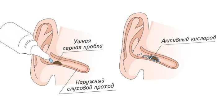 Пробка в ухе. Как удалить в домашних условиях серные пробки у детей, взрослых. Чем промыть, почистить уши – капли, перекись водорода, борная кислота