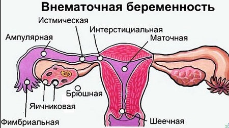 Причины боли в левом боку живота у женщин и мужчин. Характер боли и лечение