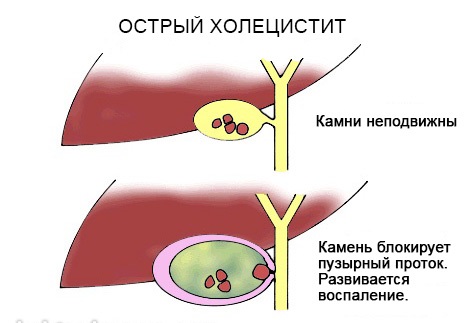 Боль под ребрами с левой, правой стороны, спереди, сбоку, сзади – что это и как лечить