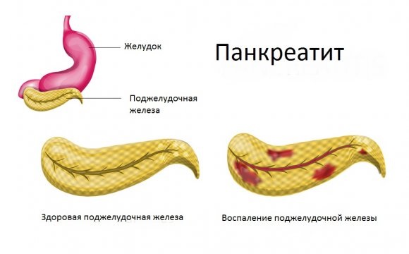 Боль под ребрами с левой, правой стороны, спереди, сбоку, сзади – что это и как лечить