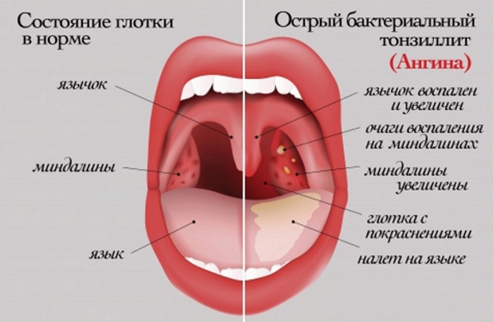 Боль в горле при глотании без температуры - острая, сильная, режущая, с одной стороны, если отдает в ухо. Лечение в домашних условиях