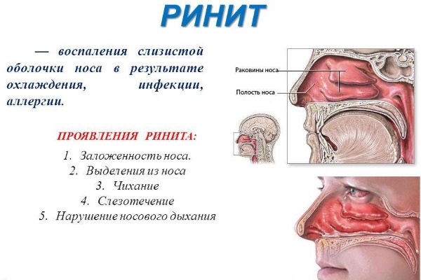 Раствор для полоскания горла: Оки, Фурацилина, сода, соль, йод, Хлорофиллипт, спиртовой, Мирамистин, Йодинол