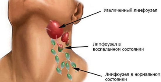 Причины и лечение воспалённых лимфоузлов на шее, если увеличенные, болят, опухли. УЗИ, диагностика и удаление