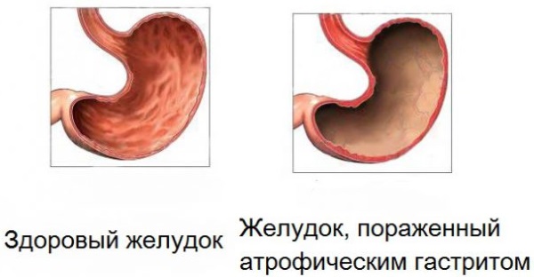 Атрофический гастрит. Симптомы и лечение у женщин народными средствами, диета, препараты