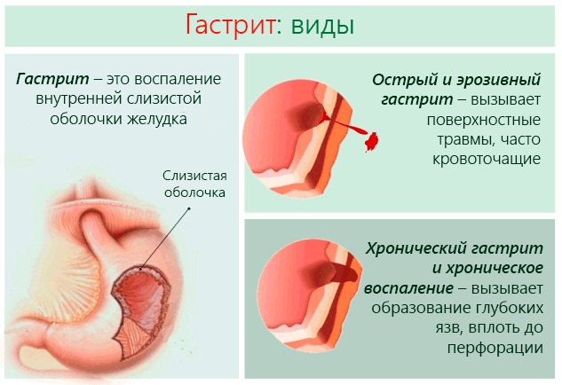 Белый язык у взрослого. Причины и лечение народными средствами. Симптомы, признаки