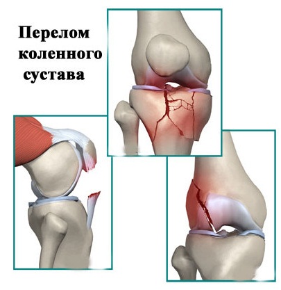 Боли в коленях. Причины, лечение при сгибании, разгибании, ходьбе, приседании и вставании. Народные средства, мази, лекарства, уколы