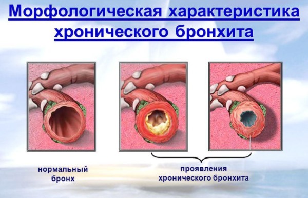 Хронический бронхит. Симптомы и лечение у взрослых. Препараты, эффективные народные средства в домашних условиях