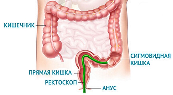 Ректороманоскопия кишечника. Что это такое, подготовка, как делается обследование у женщин, мужчин, чем лучше колоноскопии