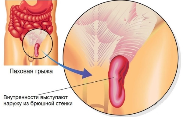 Паховая грыжа у детей мальчиков, девочек. Фото, как выглядит, симптомы, лечение, удаление