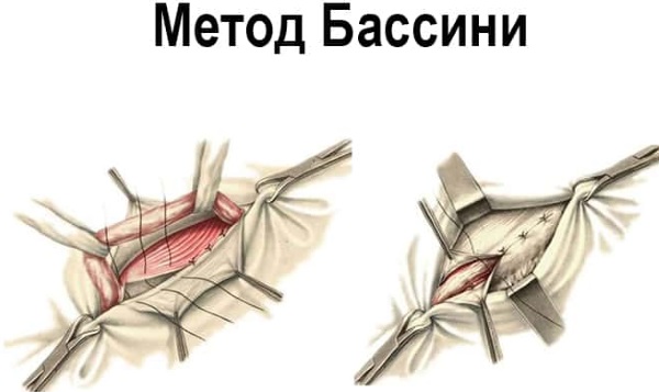 Паховая грыжа у детей мальчиков, девочек. Фото, как выглядит, симптомы, лечение, удаление