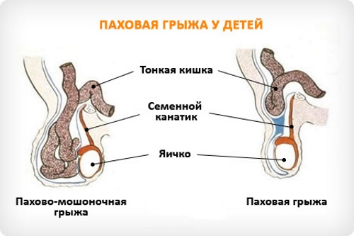 Паховая грыжа у детей мальчиков, девочек. Фото, как выглядит, симптомы, лечение, удаление