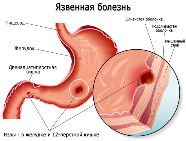 Боль в животе в области пупка у ребенка. Причины и лечение