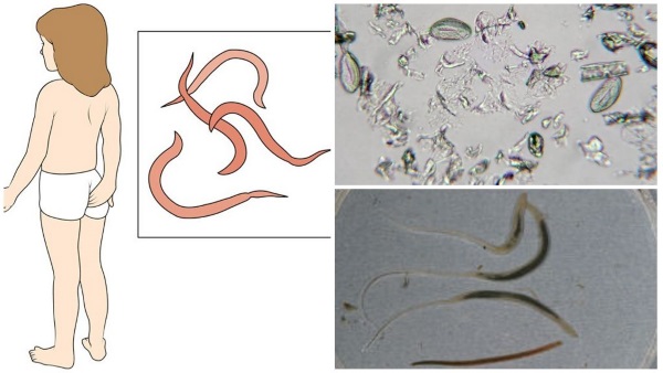 Глистная инвазия. Симптомы, диагностика и лечение у взрослых и детей