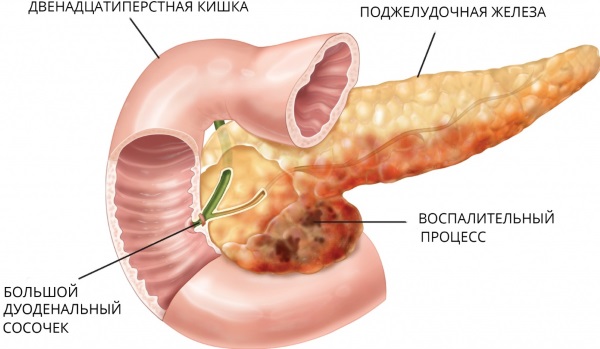 Диета при панкреатите поджелудочной железы. Меню на неделю, рецепты, продукты, что нельзя