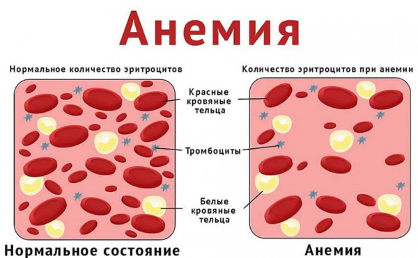 Привкус крови во рту. Причины у женщин, мужчин по утрам после кашля, бега, еды, сна, как избавиться