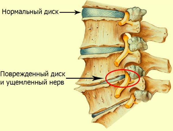 Грудной хондроз у женщин. Симптомы и лечение, как бороться