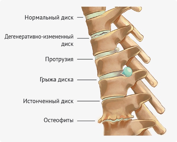 Грудной хондроз у женщин. Симптомы и лечение, как бороться