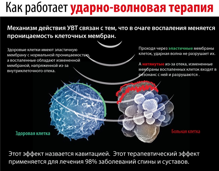 Грудной хондроз у женщин. Симптомы и лечение, как бороться