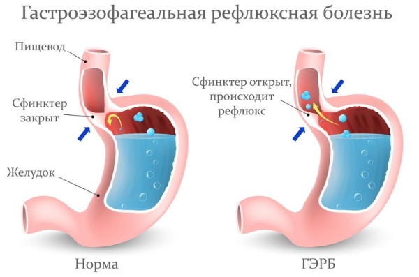 Гранулезный фарингит. Лечение у взрослых, ребенка, симптомы, опасен ли, как долго проходит