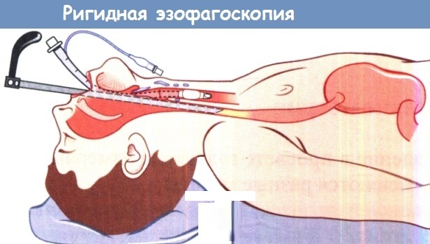 Эзофагит. Симптомы и лечение лекарствами, народными средствами, диета