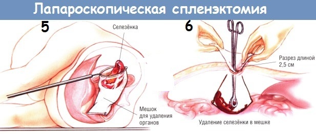 Удаление селезенки. Последствия для организма, как называется операция, диета, реабилитация