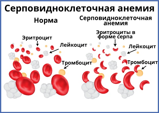 Удаление селезенки. Последствия для организма, как называется операция, диета, реабилитация