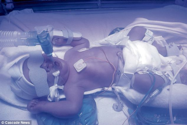 With her stomach muscles too tight, her unborn baby pushed against her kidney and so he was delivered by emergency caesarean section 10 weeks premature